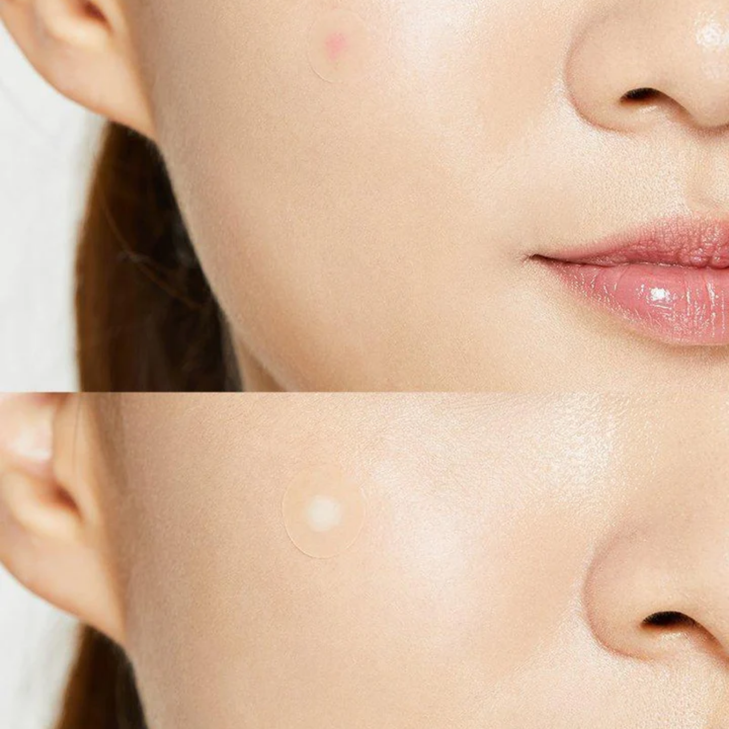 Patch anti-acné et boutons
