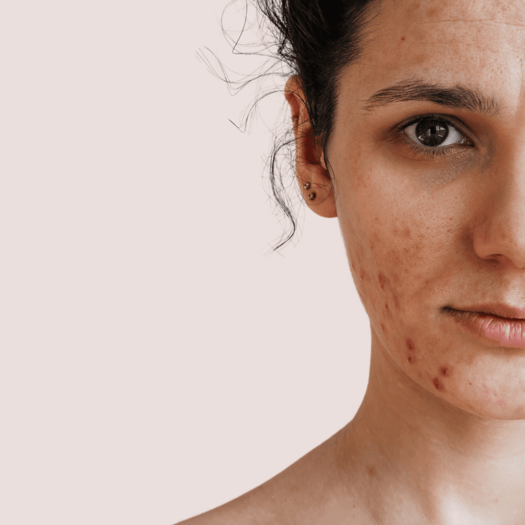 Rosacée acnéique : traitement naturel et routine